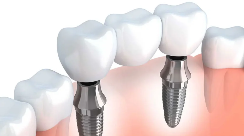 Impiantologia Dentale Classica